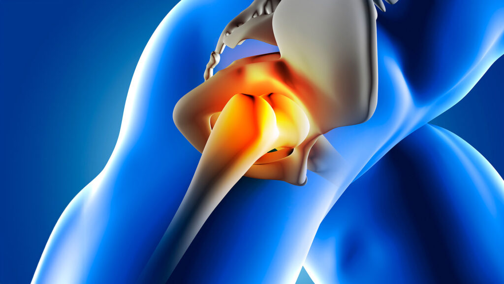 foto mostrando um raio x do quadril, para podermos falar sobre a revisão protese de quadril